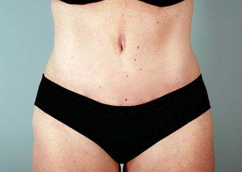 abdominoplasty-2223a-after
