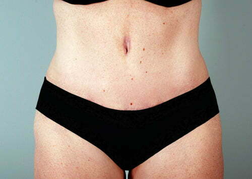 Tummy Tuck Patient 2223