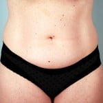 abdominoplasty-2223a-before