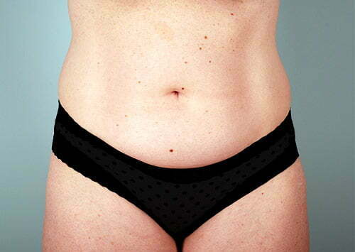 Tummy Tuck Patient 2223