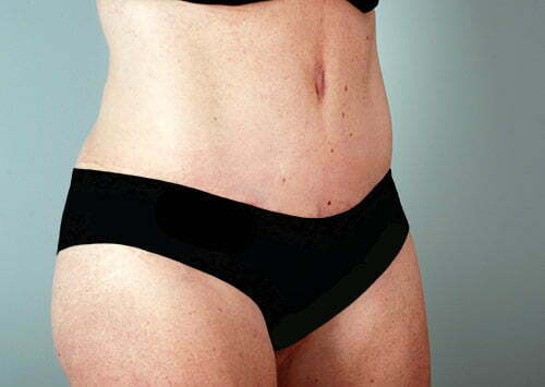 abdominoplasty-2223b-after