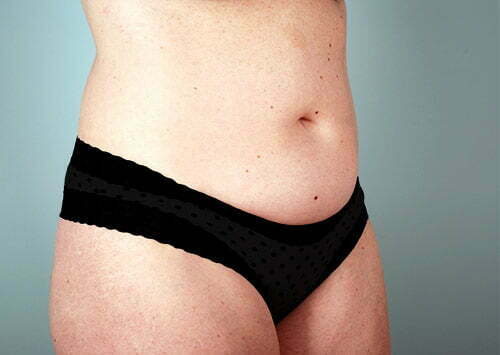 abdominoplasty-2223b-before