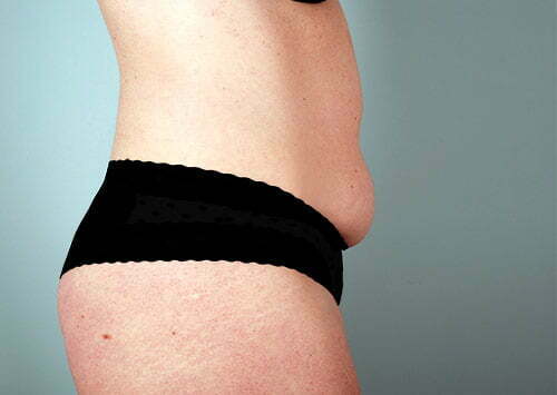 abdominoplasty-2223c-before