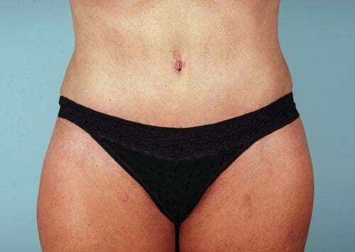 Tummy Tuck Patient 2230