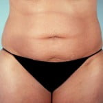 abdominoplasty-2230a-before