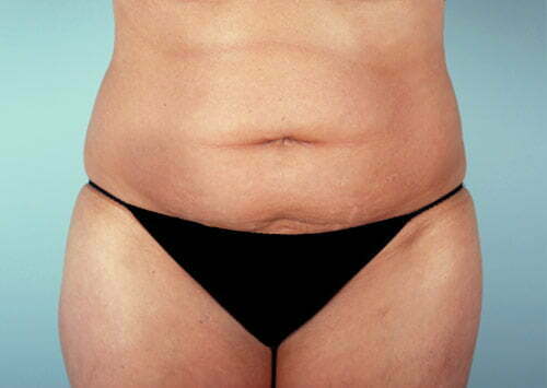 Tummy Tuck Patient 2230