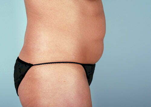 abdominoplasty-2230c-before