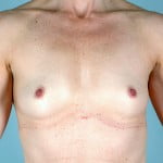 breast-augmentation-2037a-before