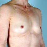 breast-augmentation-2037b-before