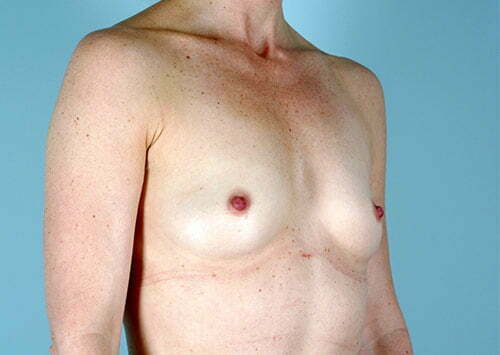 breast-augmentation-2037b-before
