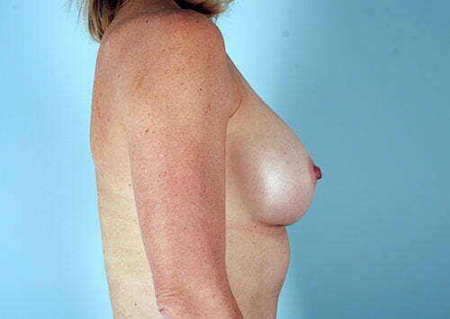 breast-augmentation-2037c-after