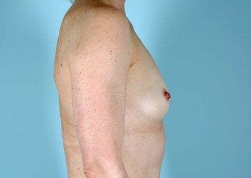 breast-augmentation-2037c-before