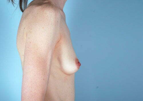 breast-augmentation-2051c-before