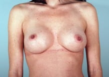 Breast Augmentation Patient 2097