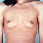 breast-augmentation-2097a-before