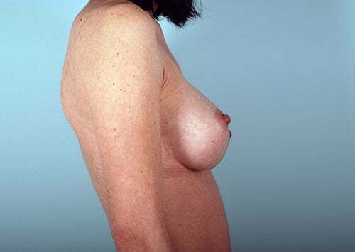 breast-augmentation-2097c-after
