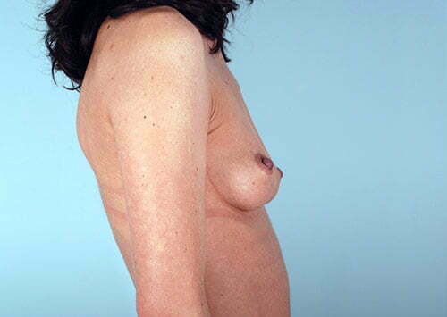 breast-augmentation-2097c-before