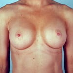 breast-augmentation-2115a-after
