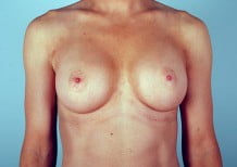 Breast Augmentation Patient 2115