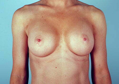 breast-augmentation-2115a-after