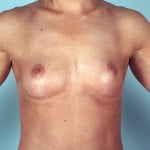 breast-augmentation-2115a-before