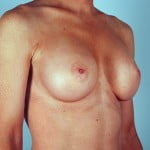 breast-augmentation-2115b-after