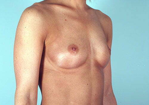 breast-augmentation-2115b-before