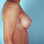 breast-augmentation-2115c-after