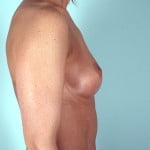 breast-augmentation-2115c-before