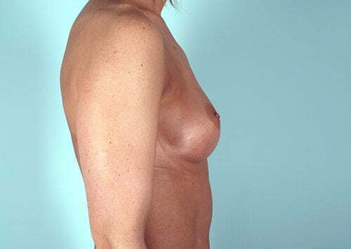 breast-augmentation-2115c-before