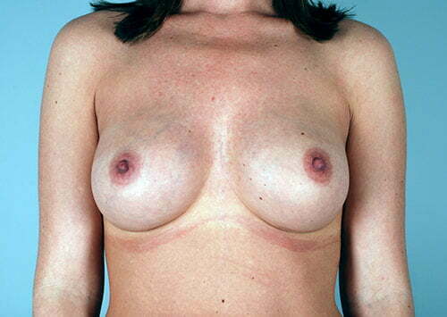 breast-augmentation-2164a-after