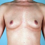 breast-augmentation-2164a-before