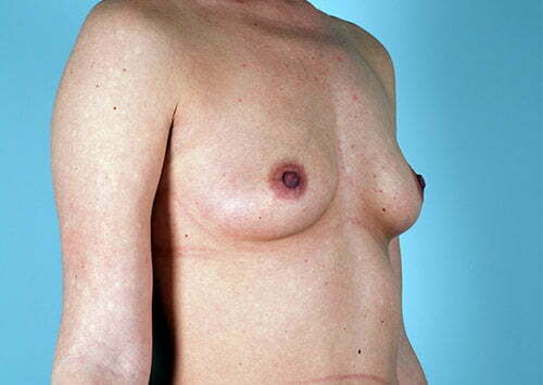 breast-augmentation-2164b-before