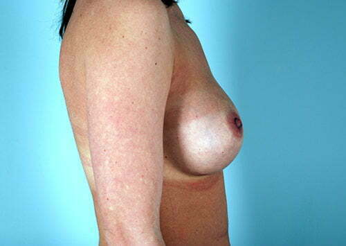 breast-augmentation-2164c-after