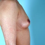 breast-augmentation-2164c-before