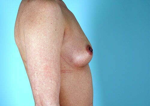 breast-augmentation-2164c-before