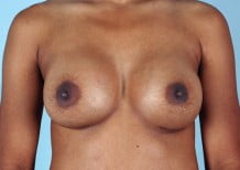 Breast Augmentation Patient 2171