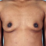 breast-augmentation-2171a-before
