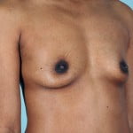 breast-augmentation-2171b-before