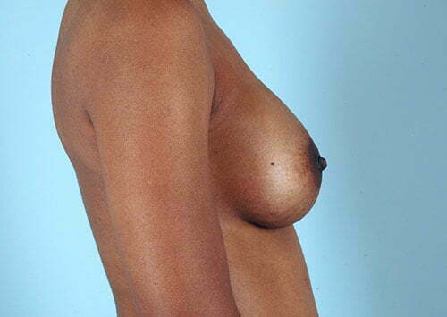 breast-augmentation-2171c-after