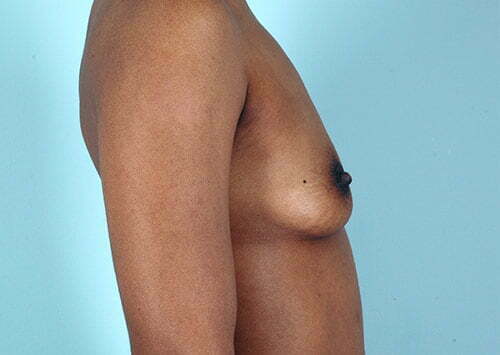 breast-augmentation-2171c-before