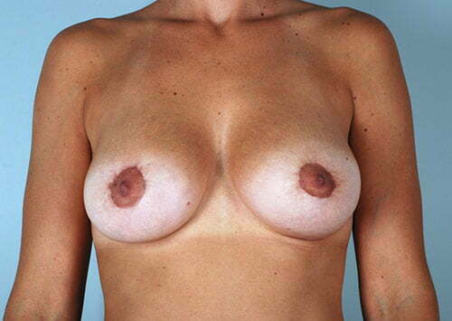 breast-lift-with-augmentation-2545a-after