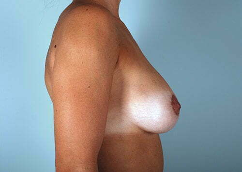 breast-lift-with-augmentation-2545c-after