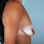 breast-lift-with-augmentation-2545c-before