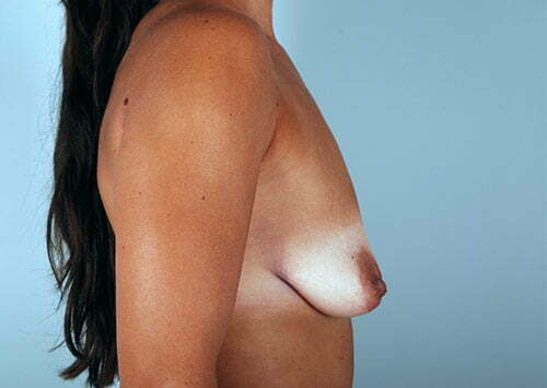 breast-lift-with-augmentation-2545c-before