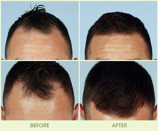 How to stop a receding hairline - Wimpole Clinic