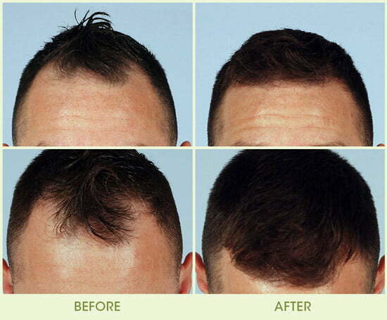 NeoGraft Hair Transplantation System  Boston Plastic Surgery