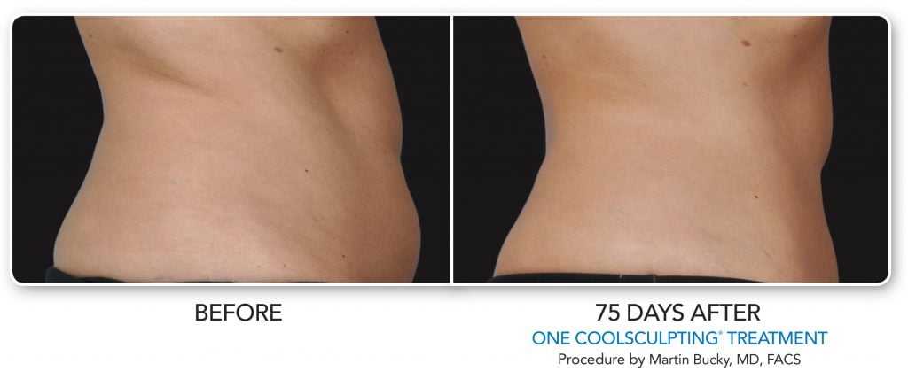 coolsculpting fat reduction results