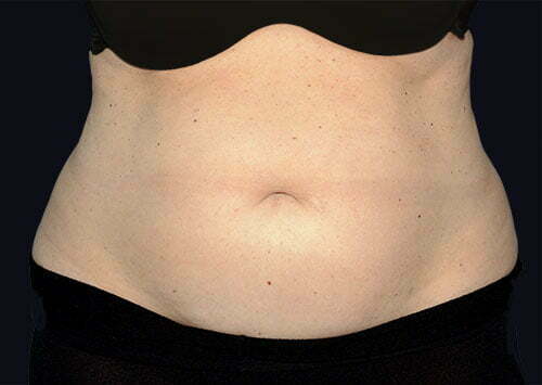 CoolSculpting