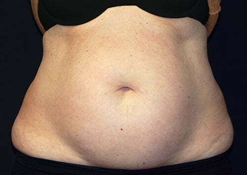 CoolSculpting